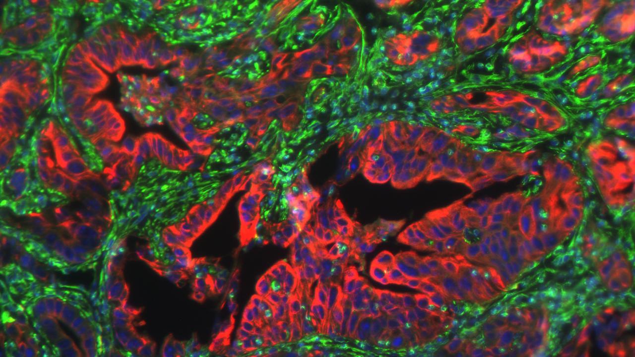 Shown here is a pancreatic tumor with experimentally depleted levels of En1, which reduces metastatic activity. (Jihao “Reno” Xu / UC Davis)