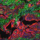 Shown here is a pancreatic tumor with experimentally depleted levels of En1, which reduces metastatic activity. (Jihao “Reno” Xu / UC Davis)